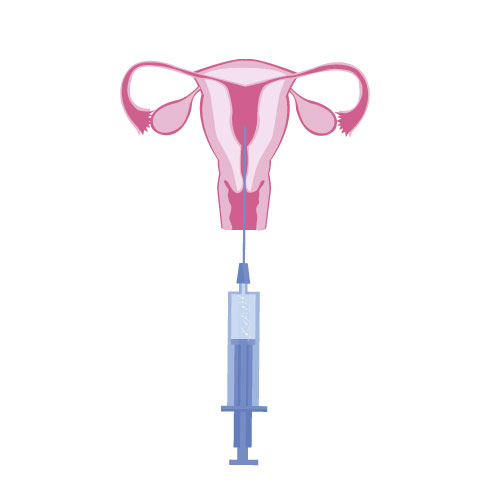 iui
